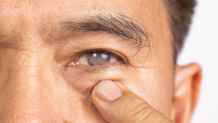 Thumbnail of Cataract Surgery: Personalised Lens Replacement for Treatment and Vision Correction