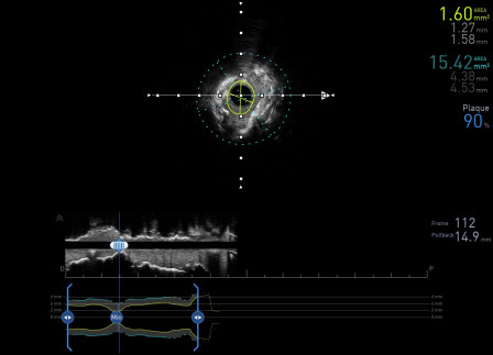 Intravascular Ultrasound Measurement