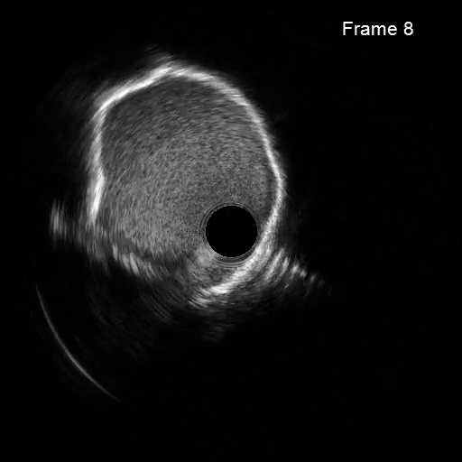 Intravascular Ultrasound Measurement