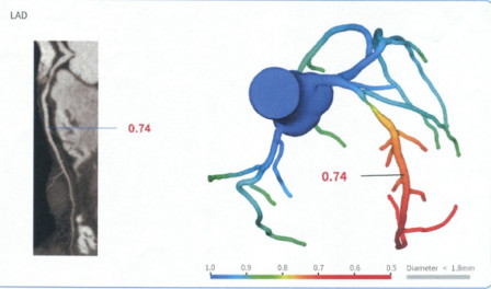 CT Fractional Flow Reserve (CT FFR)