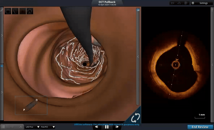Optical Coherence Tomography: Co-registration Photo with 3D Stent Rendering & 3D Visual Angioscopy