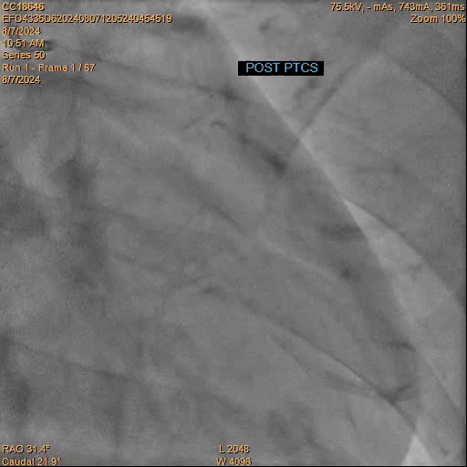 Coronary Angiogram after Stenting
