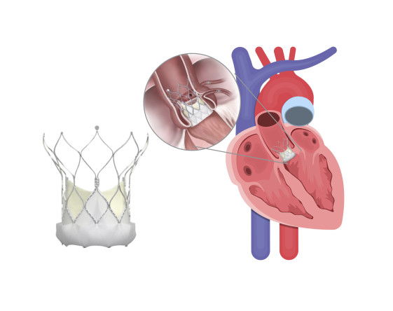 Thumbnail of Transcatheter Aortic Valve Implantation (TAVI)