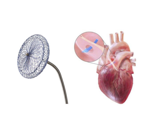 Thumbnail of Transcatheter Closure of Atrial Septal Defect (ASD)/Patent Foramen Ovale (PFO)