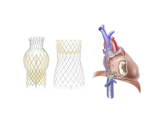 Thumbnail of Tricuspid Regurgitation Treatment: Transcatheter Tricuspid Heterotopic Valve Replacement