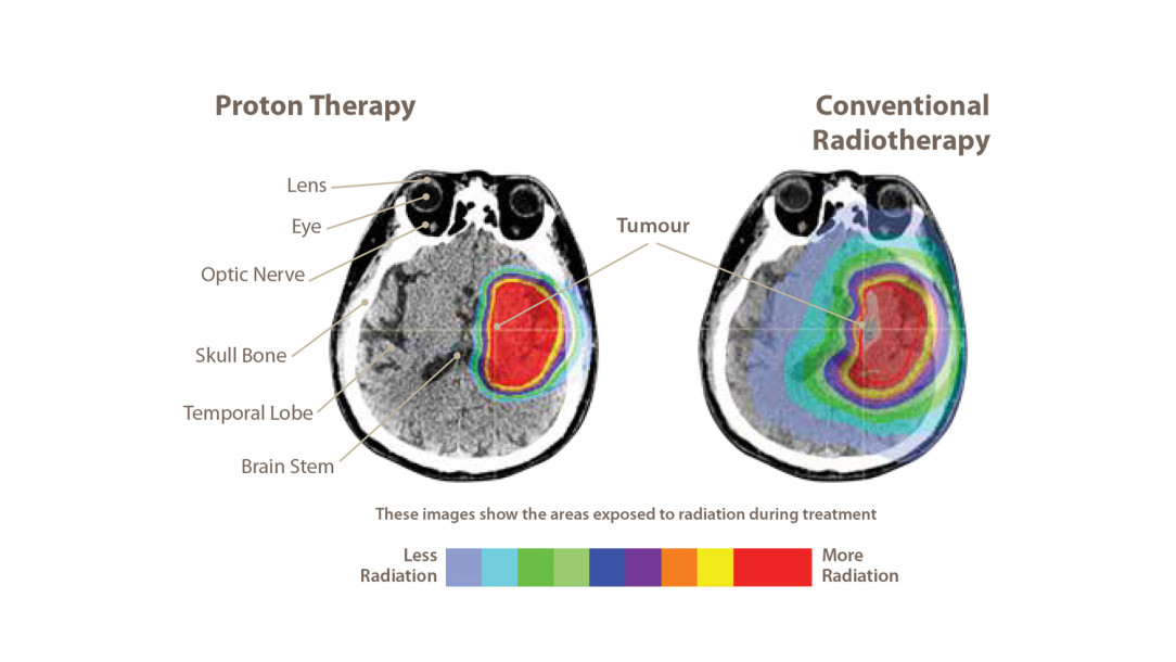 Proton Therapy vs Conventional Radiotherapy 