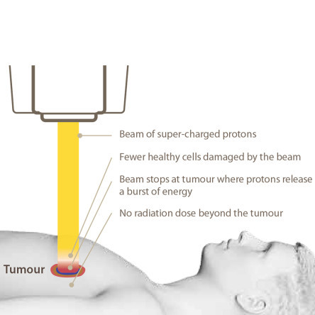 Thumbnail of Why Choose Proton Therapy?