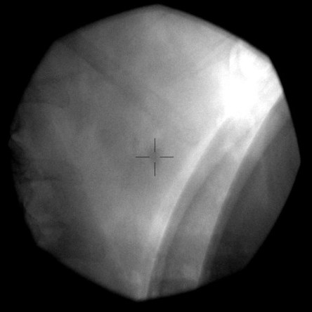 Thumbnail of About Extracorporeal Shock Wave Lithotripsy (ESWL)