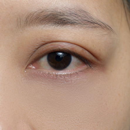 Thumbnail of Transcutaneous Lower Blepharoplasty (External Incision)