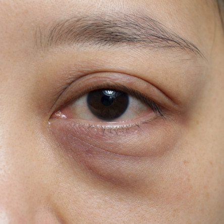 Thumbnail of Transconjunctival Lower Blepharoplasty (Internal Incision)
