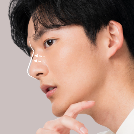 Thumbnail of Hyaluronic Acid Injection