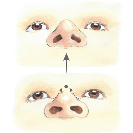 Thumbnail of Synthetic / Autologous Cartilage Implantation