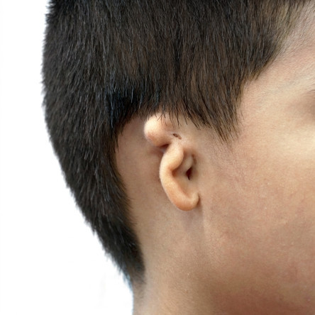 Thumbnail of Microtia