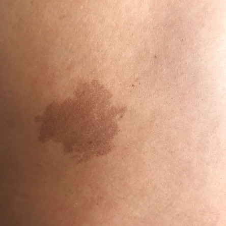 Thumbnail of Pigmented Birthmarks