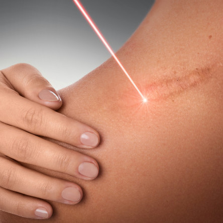 Thumbnail of Fractional Laser And Acne Scar Treatment