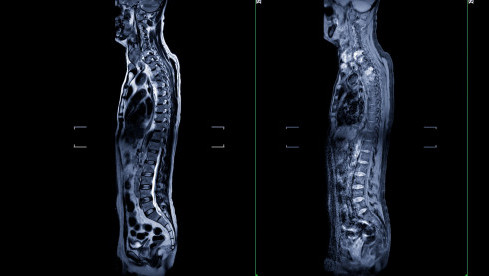 Thumbnail of Spinal Cord Injury Rehabilitation
