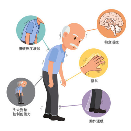 缩图 - 什么是柏金逊症