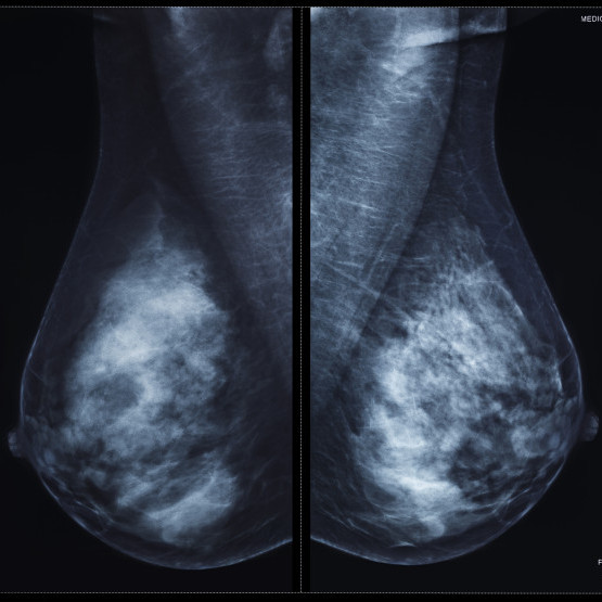 Thumbnail of Breast