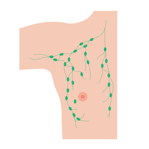 Axillary Lymph Node Surgery