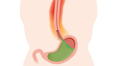 Thumbnail of Bravo® Wireless 24/96-hour Oesophageal PH Monitoring