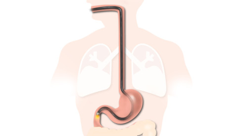 Thumbnail of Gastroscopy