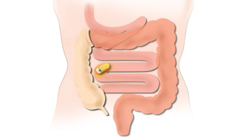 Thumbnail of Capsule Endoscopy
