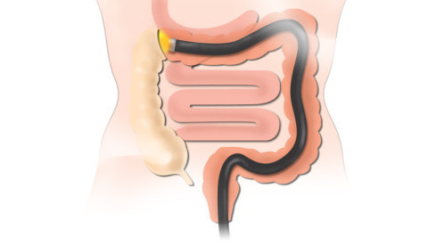 Thumbnail of Colonoscopy