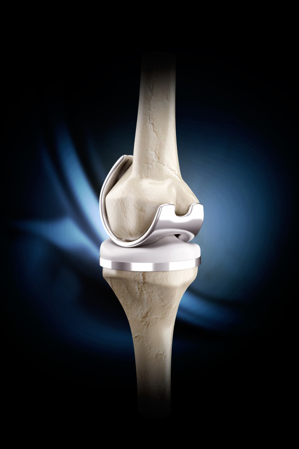 Joint Replacement Programme
