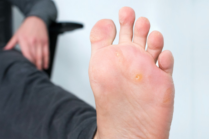 Thumbnail of Corns and Callus