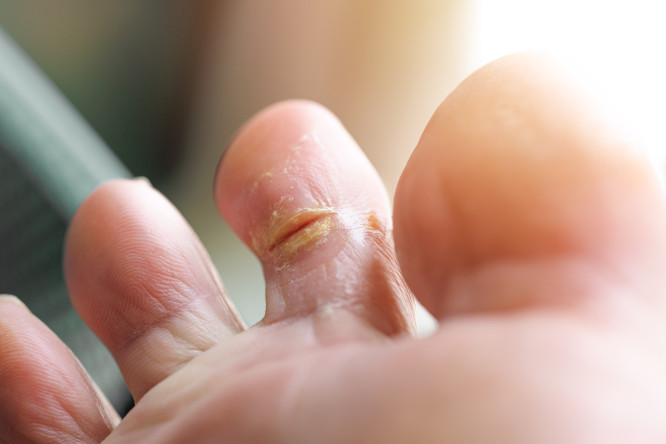 Thumbnail of Foot Wound & Ulcer