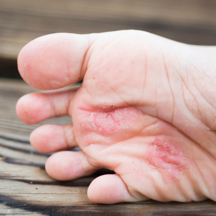 Thumbnail of Foot Fungal Skin Infection