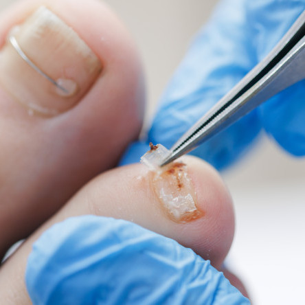 Thumbnail of Ingrown Toenail