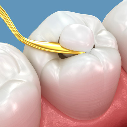 Thumbnail of Fillings