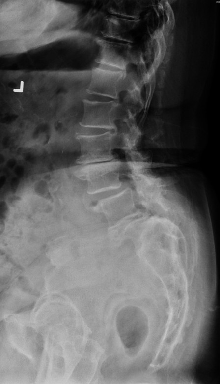 Figure 1a shows reduced intervertebral disc height and osteophytes formation.