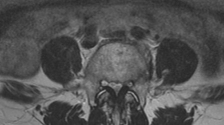 Figure 1c shows facet joint degeneration and inflammation, together with lumbar spinal stenosis.