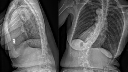 Figure 1a & 1b. These images show significant spinal deformities with truncal imbalance in both the coronal and sagittal planes.