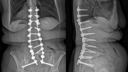 Figure 2a& 2b. These images show improved postoperative spinal curvature after surgery.