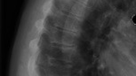Figure 2. Lateral x ray image shows collapse of vertebral body.