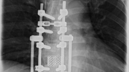 Figure 3. X-ray image shows complete excision of T8 vertebra.
