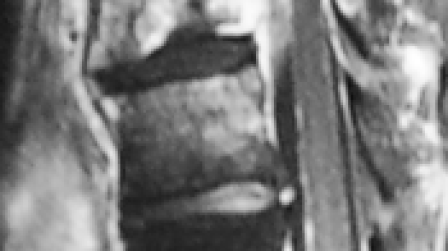 Figure 2. This MRI image shows a common pattern of TB spine with predominant vertebral destruction and sub-ligamentum spread of abscess. However, TB spine can mimic many other spinal diseases and is difficult to be diagnosed without biopsy.