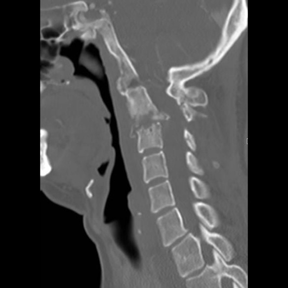 Spinal Infection