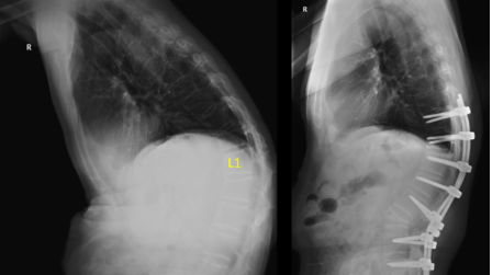 Figure 1. This was a known patient with ankylosing spondylitis and kyphosis. Osteotomy was performed to correct the deformity.