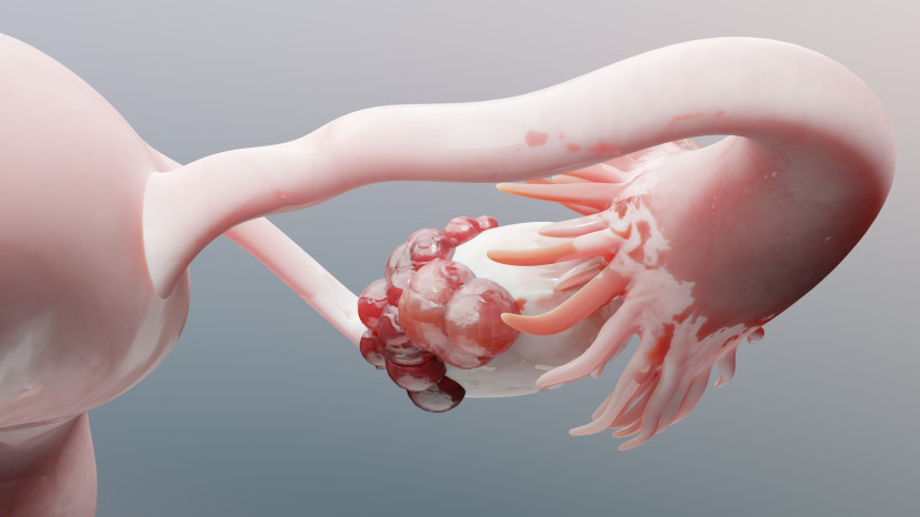Thumbnail of Ovarian Cancer