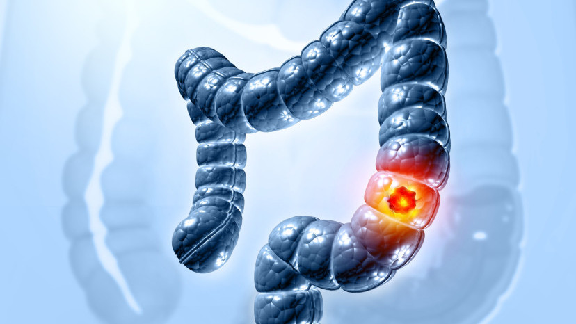 Thumbnail of Colorectal Cancer