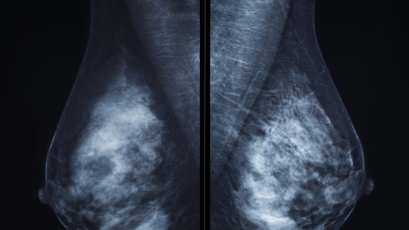 Thumbnail of Breast Cancer