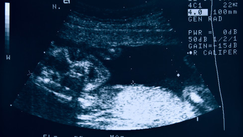 Thumbnail of Routine Foetal Morphology Scan (18-22 weeks of gestation)