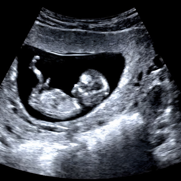  Early Foetal Morphology Scan
