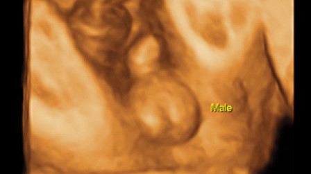 3D foetal genital organ in a male fetus at 28 weeks