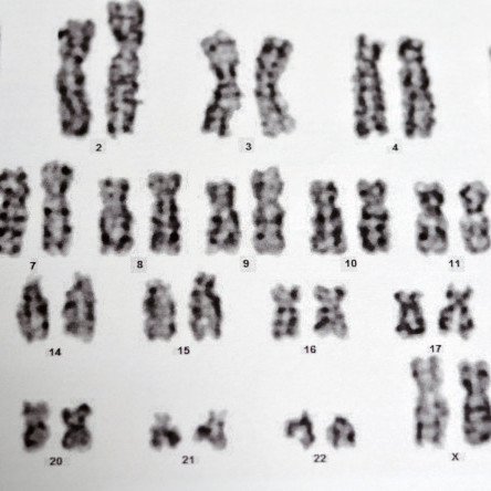 Thumbnail of Non-invasive Foetal DNA testing (safe T21)