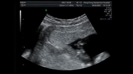 Chorionic Villus Sampling